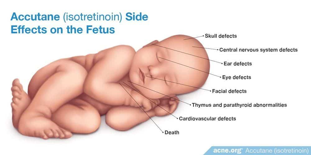 Các biến chứng ảnh hưởng đến thai nhi của Isotretinoin: Suy nhược hệ thần kinh trung ương, khuyết tật tai, mắt, dị tật trên khuôn mặt, bất thường tuyến cận giáp, khuyết tật hệ tim mạch.