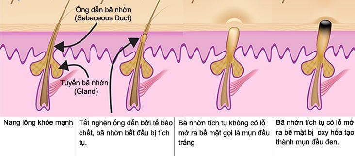 Quá trình hình thành mụn